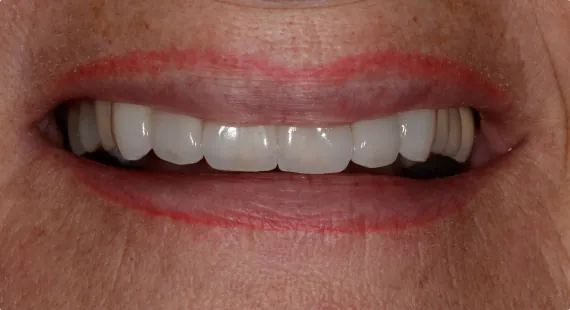 Case 1 — After